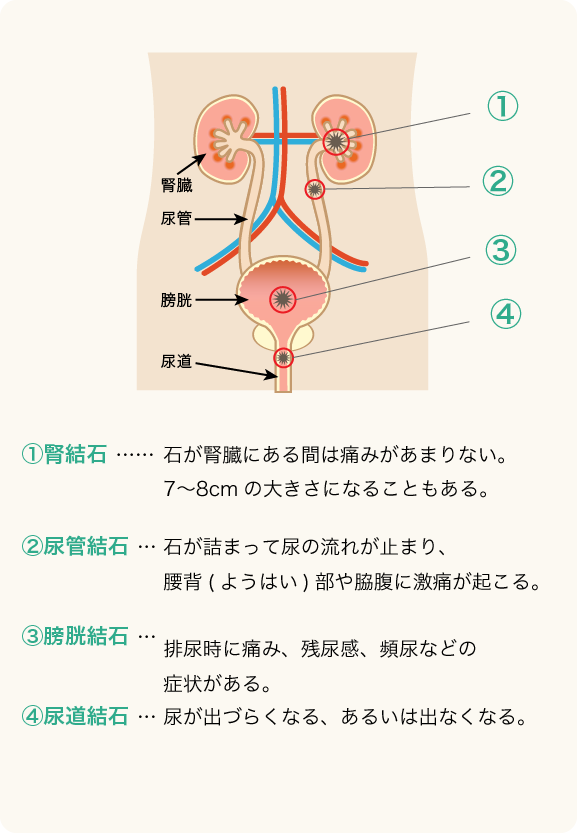 尿路結石外来｜伊丹市 こいだ腎泌尿器科クリニック｜阪急伊丹駅より